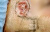 Basal-Cell Carcinoma