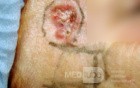 Basal-Cell Carcinoma