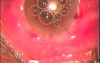 Phakoemulsifikation And Microciliary Filtration
