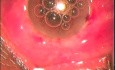 Phakoemulsifikation And Microciliary Filtration
