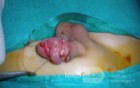 Penis Injury  Another  Intra-Operative Photo