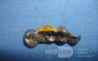 Dental Prothesis Found in the Jejuno (6 of 9)