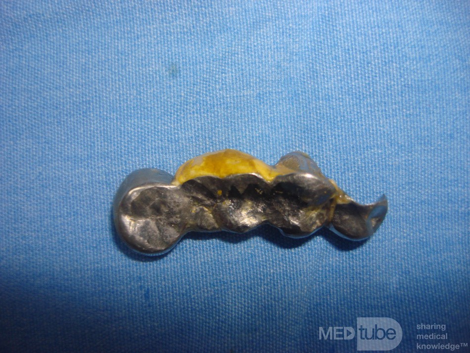 Dental Prothesis Found in the Jejuno (6 of 9)
