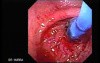 Esophageal Achalasia (7 of 10)