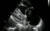Pulmonary Embolism