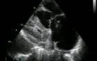 Pulmonary Embolism