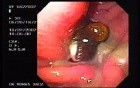 Gastric Cancer - Perzzev Catheter