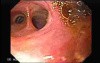 Choledocoduodenostomy and The Sump Syndrome (1 of 10)