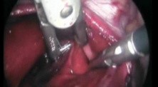 Left Pleura Rupture During Laparoscopy