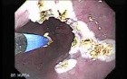 Barrett's Esophagus of long segment (7 of 11)