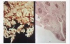 Rheumatoid arthritis - Joint - Histopathology