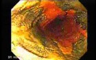 Endoscopic view of Barrett Esophagus - chromoendoscopy using Lugol's solution (5 of 9)