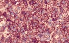 Gastrointestinal Stromal tumor (GIST) (63 of 65)
