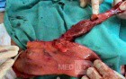 Barrett Adenocarcinoma - Endoscopic Image (13 of 20)
