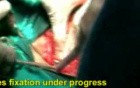 Surgical Treatment Of Pelvic Fractures