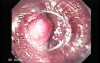 Early Gastric Cancer of the Gastroesophageal Junction - Procedure of Mucosectomy, Part 1