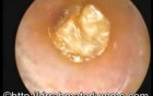 Foreign Body In The Ear Passage