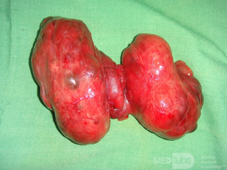 Toxic Goiter- total thyriodectomy