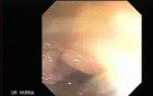 Cap polyposis that resemble a adenocarcinoma of the rectum (1 of 7)