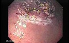 Gastrointestinal Stromal Tumor - GIST (9 of 65)