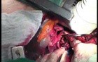 Right Nephrectomy With Sternotomy- Clear Cell Carcinoma Of The Right Kidney With Carcenous Thrombus In Right Atrium