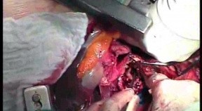Right Nephrectomy With Sternotomy- Clear Cell Carcinoma Of The Right Kidney With Carcenous Thrombus In Right Atrium