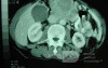 Gastric Ulcer with Gastrocolic fistula due to a Zollinger-
 Ellison Syndrome (32 of 33)