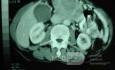 Gastric Ulcer with Gastrocolic fistula due to a Zollinger-
 Ellison Syndrome (32 of 33)