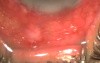 Pupillary Block Glaucoma - Fugo Blade Treatment