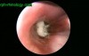 Bronchoscopy In A 15 Months Old Child
