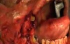 Carotid  Artery  Glomus  Chemodactoma  tumor  Surgery  Head  Neck  
