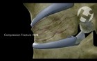 Compression Fracture vs. Displaced Shear Fracture