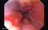 Barrett Esophagus (2 of 6)