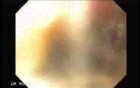 Synchronous Cancer (Gastric and Esophageal) -the Case of 60 Years-Old Man