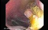 Colonoscopic Polypectomy (14 of 29)