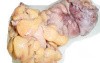 Rectal Adenocarcinoma (2 of 7)