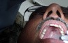 Greater Palatine Anesthesia With Ice - Take 5