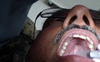 Greater Palatine Anesthesia With Ice - Take 5