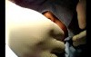 Hair transplantation surgical video
