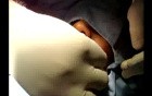 Hair transplantation surgical video