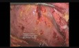 Laparoscopic Cholecystectomy