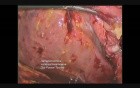 Laparoscopic Cholecystectomy