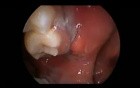 Mouth Boils - Buccoalveolar Sulcus