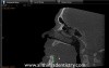 Mandibular Implant Placement - Review Of 2 Implant Case