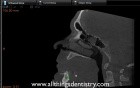 Mandibular Implant Placement - Review Of 2 Implant Case