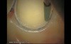 Final Preparation For Aesthetic Veneers (4/4)