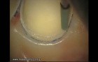 Final Preparation For Aesthetic Veneers (4/4)