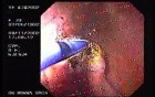 Dieulafoy´s Lesion (Exulceratio Simplex) (8 of 11)