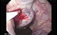 Severe Variceal Bleeding - Sclerotherapy