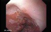 Barrett Esophagus - Endoscopic Close View